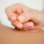 Gentle acupuncture technique.